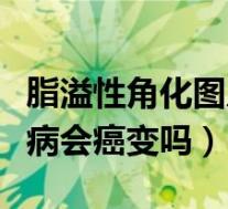 脂溢性角化图片和黑色素瘤对比(脂溢性角化病会癌变吗)