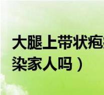 大腿上带状疱疹会传染家人吗（带状疱疹会传染家人吗）